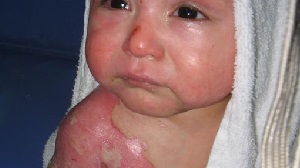 Pediatric Burn Center